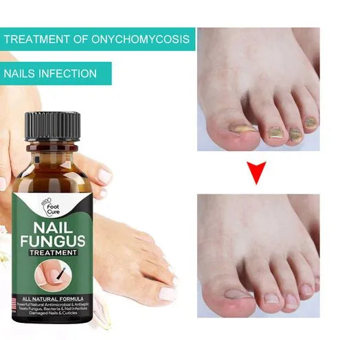 Nail Fungal Repair Serum | Nail Fungus Removal Gel 6 Reviews