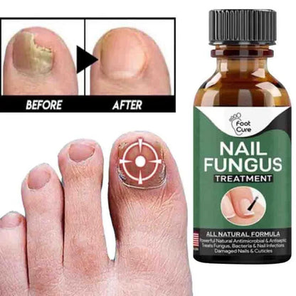 Nail Fungal Repair Serum | Nail Fungus Removal Gel 6 Reviews